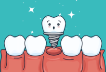 Dental Implants in Castle Hill: What to Know Before You Start