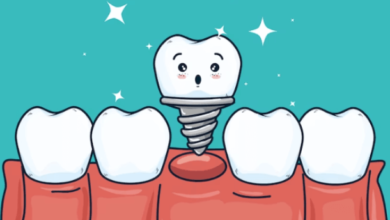 Dental Implants in Castle Hill: What to Know Before You Start