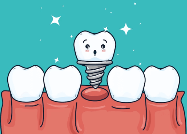 Dental Implants in Castle Hill: What to Know Before You Start