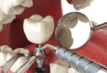 Innovative Implant Materials Redefining Dental Restoration