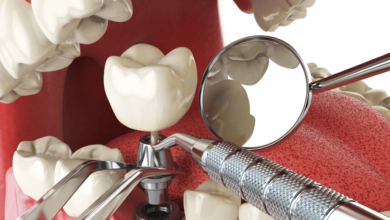 Innovative Implant Materials Redefining Dental Restoration