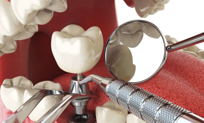 Innovative Implant Materials Redefining Dental Restoration